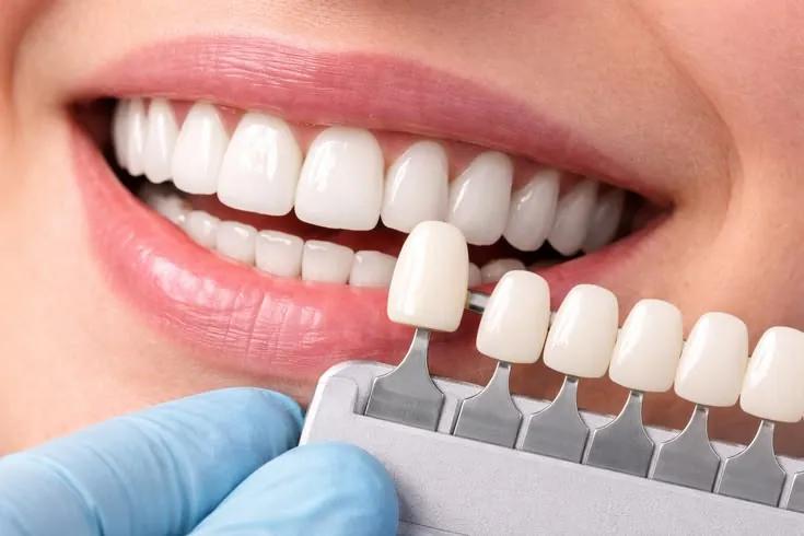 Escala de cor dental posicionada ao lado do sorriso para avaliação da tonalidade
